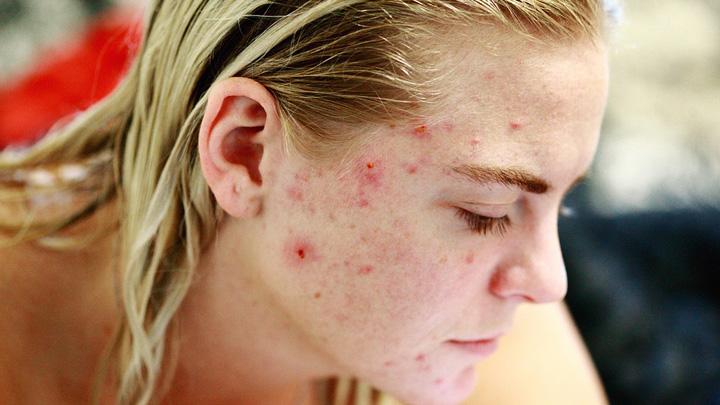 Apa Itu Jerawat Batu? Kenali Ciri-ciri, Penyebab dan Cara Menghilangkannya