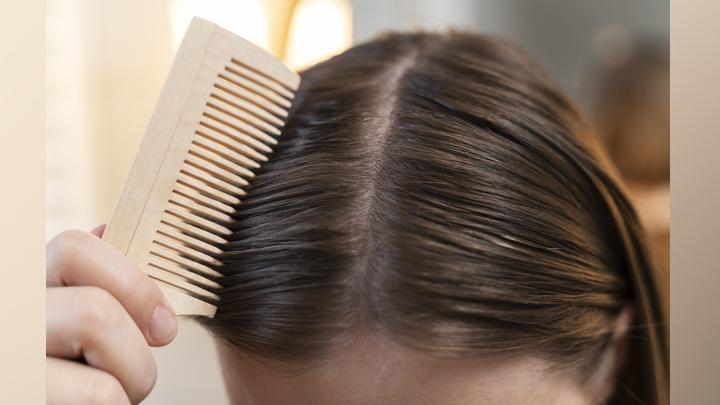 Penyebab Jerawat di Kulit Kepala dan Cara Mengatasinya